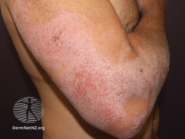 File:Arm eczema (DermNet NZ dermatitis-atopic38).jpg