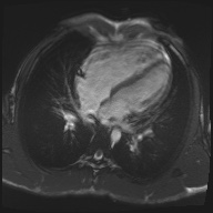 File:Arrhythmogenic right ventricular cardiomyopathy (Radiopaedia 57972-64966 A 24).jpg