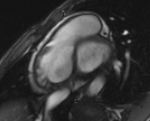 Arrhythmogenic right ventricular cardiomyopathy (Radiopaedia 69564-79464 short axis cine 231).jpg