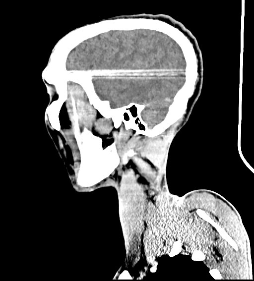 Arrow injury to the brain (Radiopaedia 72101-82607 H 19).jpg