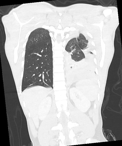 Arrow injury to the chest (Radiopaedia 85367-100975 Coronal lung window 99).jpg