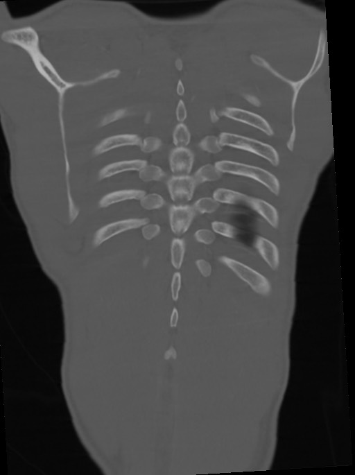 Arrow injury to the neck (Radiopaedia 75225-86323 Coronal bone window 104).jpg
