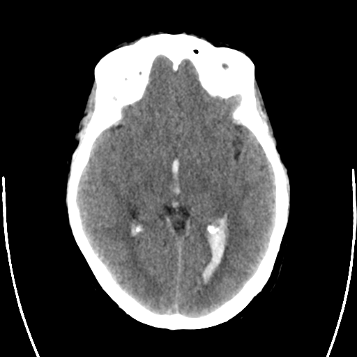 File:Arteriovenous malformation (cerebral) (Radiopaedia 40070-42579 Axial non-contrast 15).png