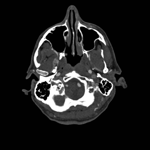 File:Artery of Percheron infarct (Radiopaedia 48088-52894 A 107).jpg
