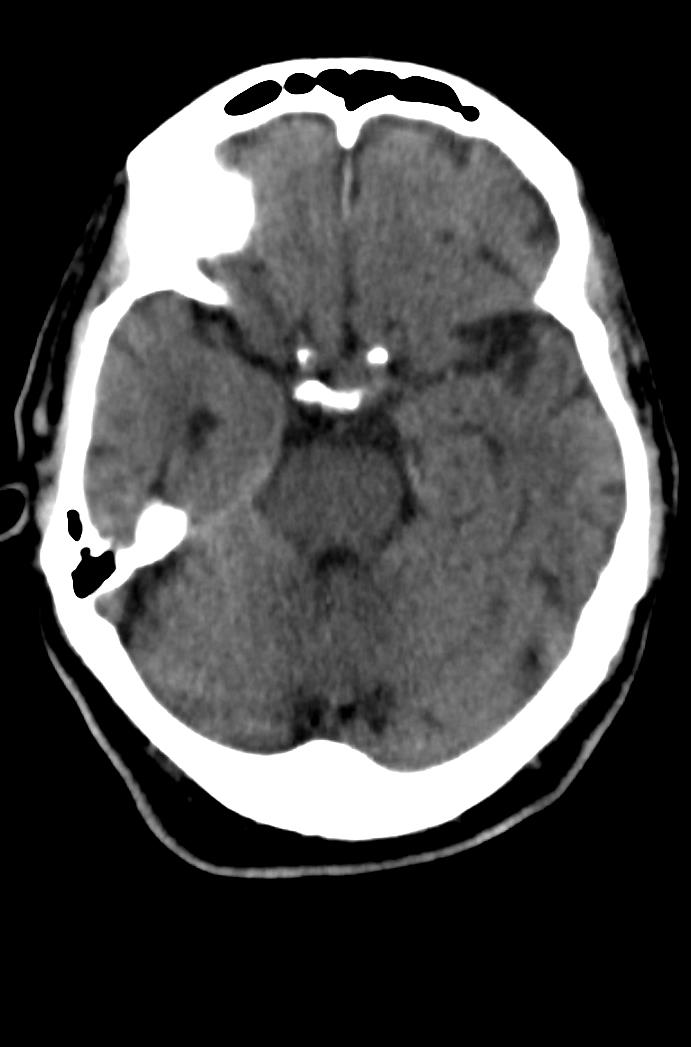 Artery of Percheron infarction (Radiopaedia 80613-94202 Axial non-contrast 69).jpg