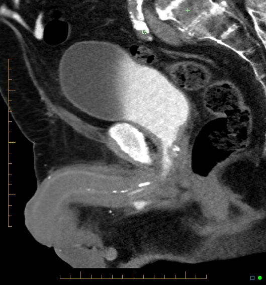 File:Artificial urethral sphincter (Radiopaedia 46937-51464 Sagittal C+ delayed 20).jpg