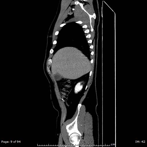Ascending aortic aneurysm (Radiopaedia 50086-55404 C 7).jpg