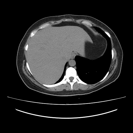 Ascending retrocecal appendicitis with liver abscesses (Radiopaedia 60066-67615 Axial non-contrast 14).jpg