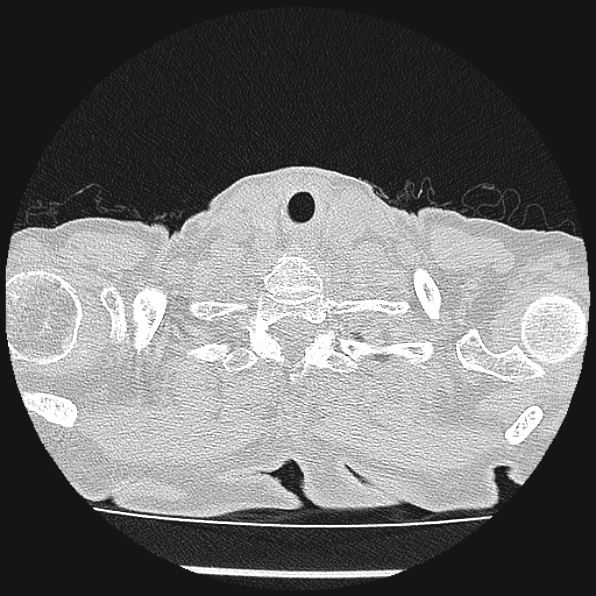 Aspergilloma (Radiopaedia 24458-24763 Axial lung window 2).jpg