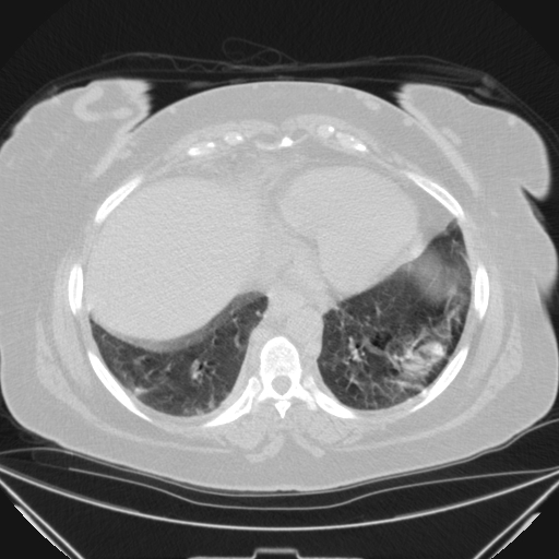 File:Aspergilloma (Radiopaedia 39611-41932 Axial lung window 100).jpg