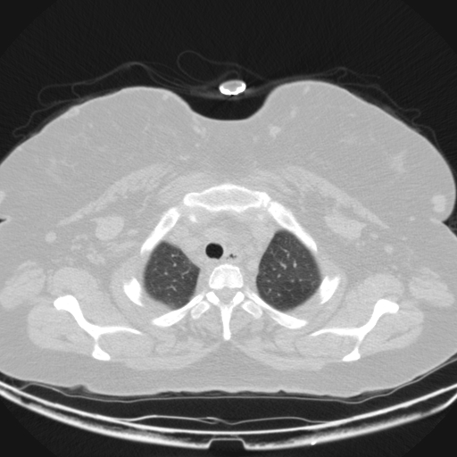 Aspergilloma (Radiopaedia 39611-41932 Axial lung window 11).jpg