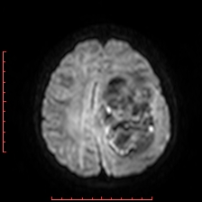 Astroblastoma (Radiopaedia 74287-85162 Axial DWI 72).jpg