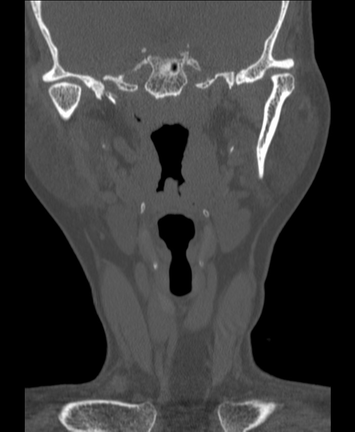 Atlanto-occipital assimilation with basilar invagination (Radiopaedia 70122-80188 Coronal bone window 3).jpg