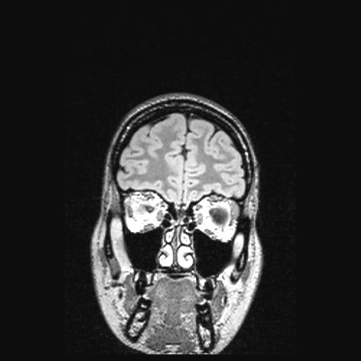 Atretic encephalocoele with inferior vermis hypoplasia (Radiopaedia 30443-31108 Coronal FLAIR 150).jpg