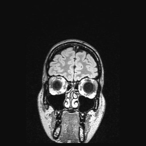 Atretic encephalocoele with inferior vermis hypoplasia (Radiopaedia 30443-31108 Coronal FLAIR 154).jpg