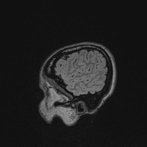 Atretic encephalocoele with inferior vermis hypoplasia (Radiopaedia 30443-31108 Sagittal FLAIR 29).jpg