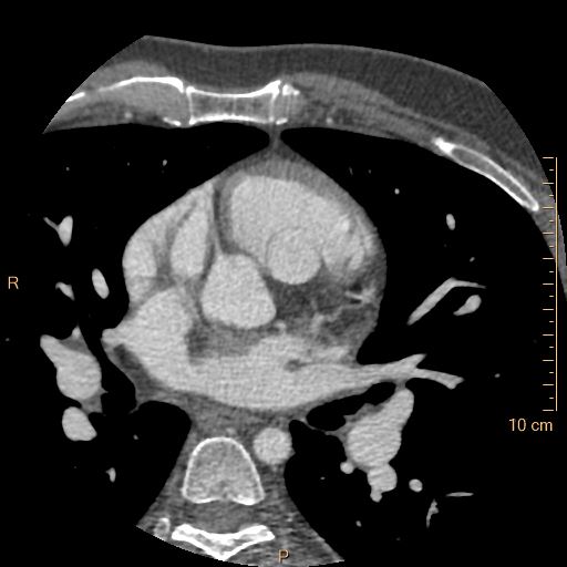 Atrial septal defect (upper sinus venosus type) with partial anomalous pulmonary venous return into superior vena cava (Radiopaedia 73228-83961 A 98).jpg