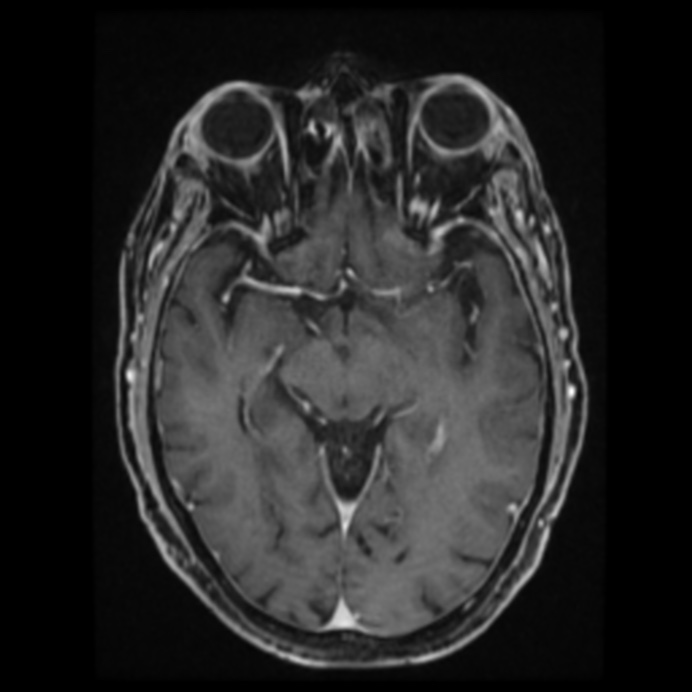 Atypical meningioma (Radiopaedia 45535-49629 Axial T1 C+ 34).jpg