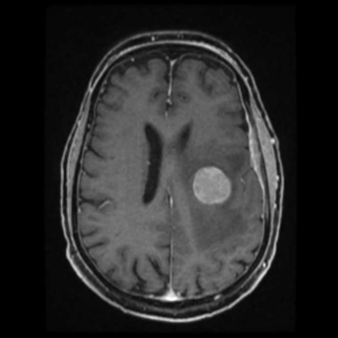 Atypical meningioma (Radiopaedia 45535-49629 Axial T1 C+ 45).jpg