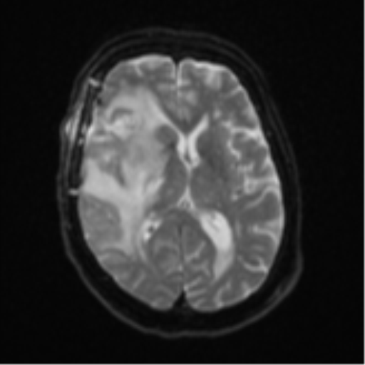 File:Atypical meningioma (WHO Grade II) (Radiopaedia 54742-60981 Axial DWI 15).png