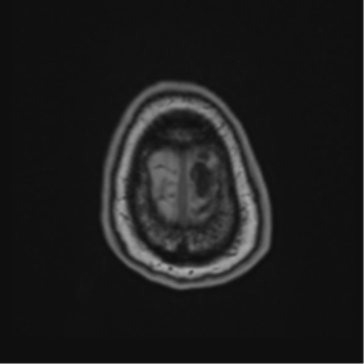 File:Atypical meningioma (WHO Grade II) (Radiopaedia 54742-60981 Axial T1 67).png