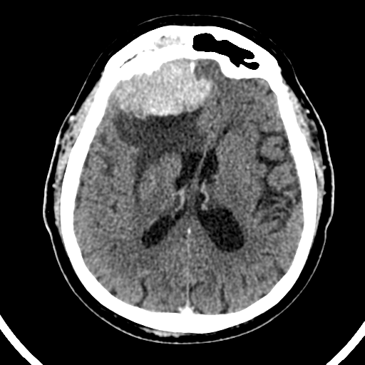 File:Atypical meningioma (WHO grade II) with brain invasion (Radiopaedia 57767-64728 Axial C+ 26).png