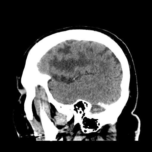 Atypical meningioma (WHO grade II) with brain invasion (Radiopaedia 57767-64728 Sagittal C+ 10).png