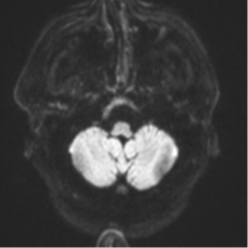 Atypical meningioma (WHO grade II) with brain invasion (Radiopaedia 57767-64729 Axial DWI 35).png