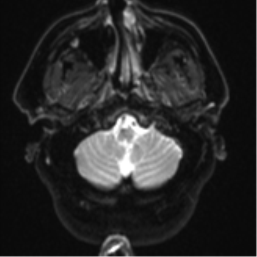 File:Atypical meningioma (WHO grade II) with brain invasion (Radiopaedia 57767-64729 Axial DWI 4).png