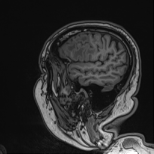 Atypical meningioma (WHO grade II) with brain invasion (Radiopaedia 57767-64729 Sagittal T1 54).png