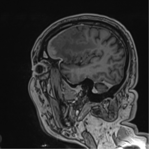 File:Atypical meningioma (WHO grade II) with brain invasion (Radiopaedia 57767-64729 Sagittal T1 C+ 51).png