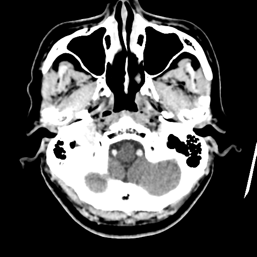 Atypical meningioma (WHO grade II) with osseous invasion (Radiopaedia 53654-59715 Axial C+ delayed 9).png