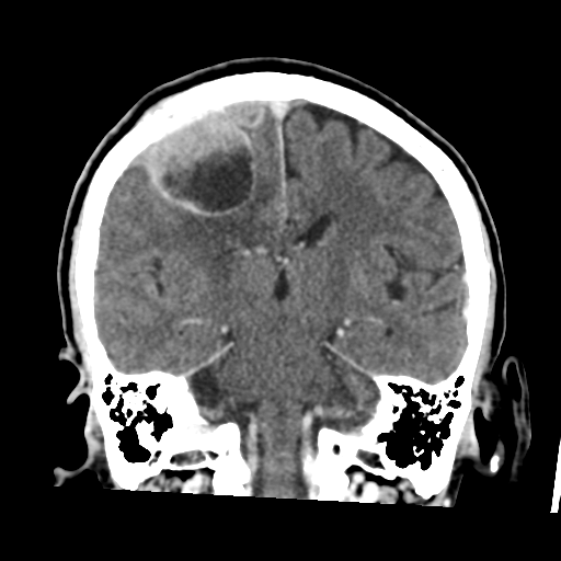 Atypical meningioma with skull invasion (Radiopaedia 34357-35649 Coronal C+ delayed 35).png