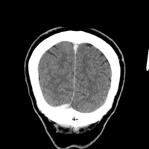 Atypical meningioma with skull invasion (Radiopaedia 34357-35649 Coronal C+ delayed 53).png