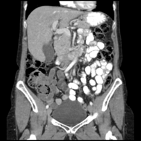 File:Atypical renal cyst (Radiopaedia 17536-17251 C 24).jpg