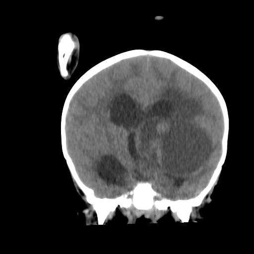 Atypical teratoid rhabdoid tumor (AT-RT) (Radiopaedia 85823-101654 Coronal non-contrast 26).jpg