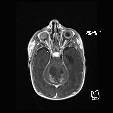 Atypical teratoid rhabdoid tumor (prenatal US and neonatal MRI) (Radiopaedia 59091-66388 Axial T1 C+ 21).jpg