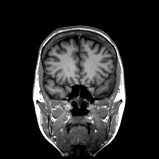 Autoimmune limbic encephalitis (Radiopaedia 30363-31005 Coronal T1 41).jpg