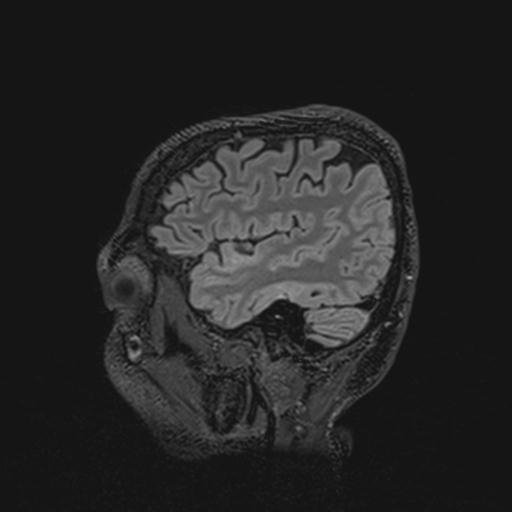 Autoimmune limbic encephalitis (Radiopaedia 30363-31005 Sagittal FLAIR 37).jpg