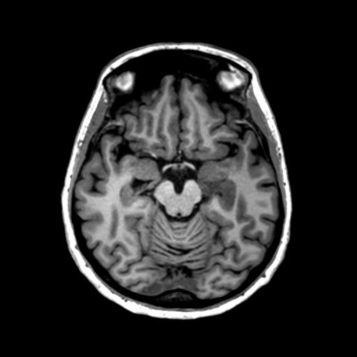 Autoimmune limbic encephalitis (Radiopaedia 30363-31005 T1 Axial 1mm 62).jpg
