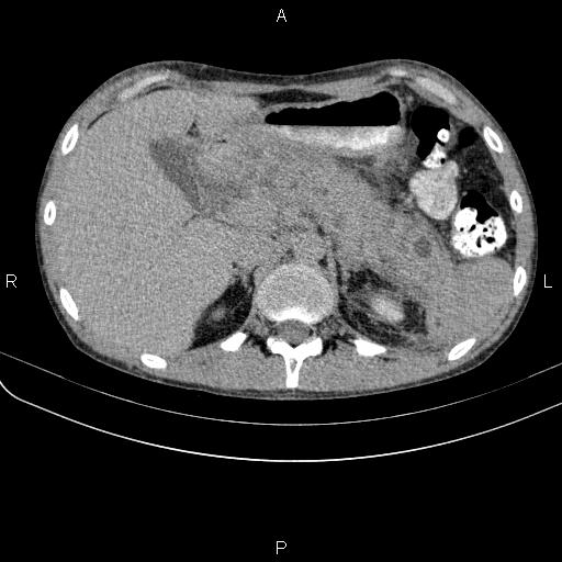 Autoimmune pancreatitis (Radiopaedia 84925-100431 Axial C+ delayed 18).jpg