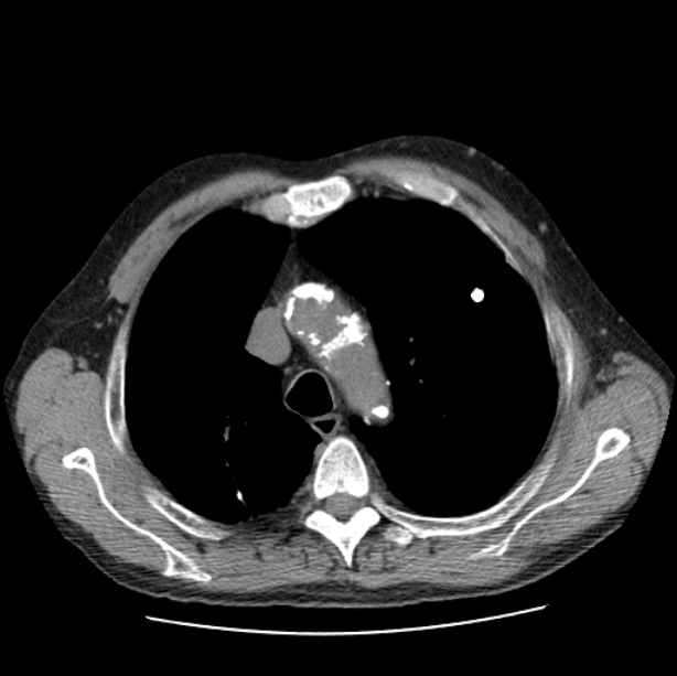 Autosomal dominant polycystic kidney disease (Radiopaedia 27851-28094 Axial non-contrast 15).jpg
