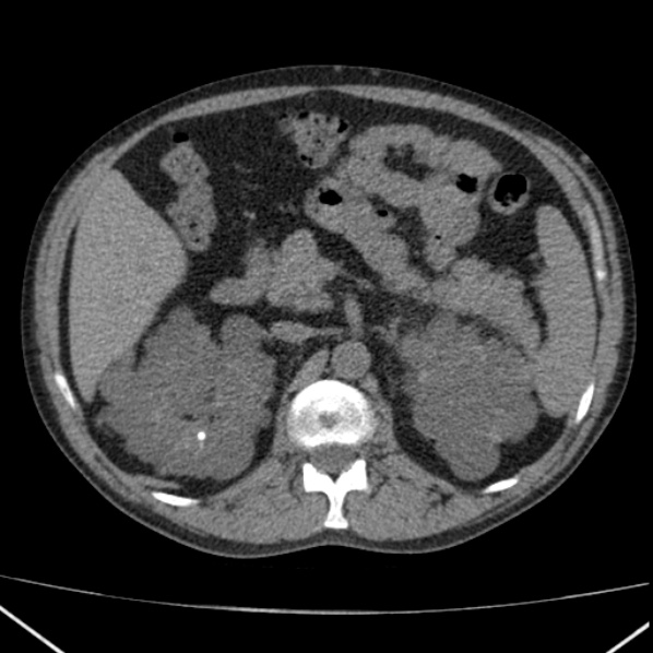 File:Autosomal dominant polycystic kidney disease (Radiopaedia 36539-38101 Axial non-contrast 30).jpg