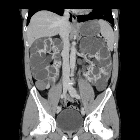 Autosomal dominant polycystic kidney disease (Radiopaedia 66349-75582 A 43).jpg