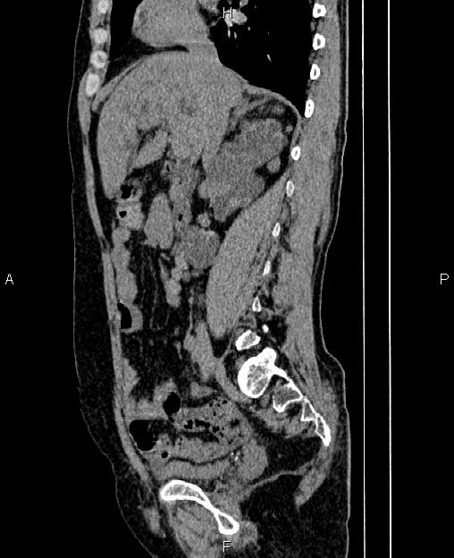 Autosomal dominant polycystic kidney disease (Radiopaedia 87830-104287 C 35).jpg