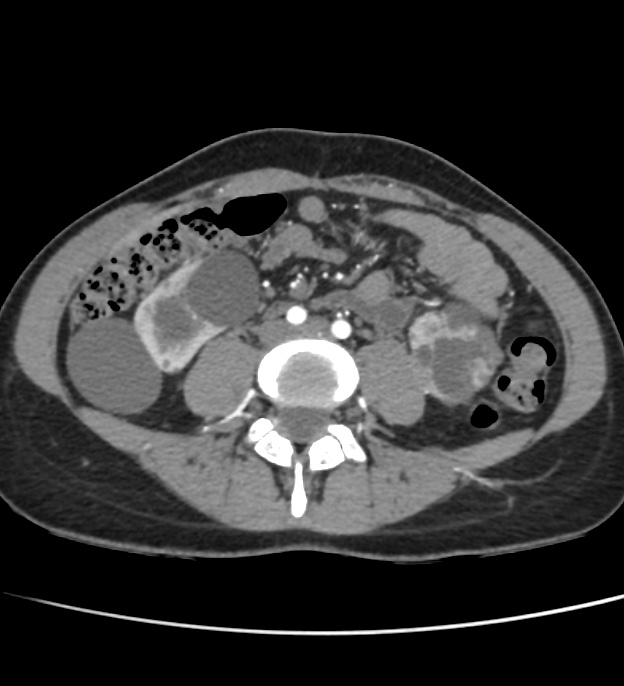 Autosomal dominant polycystic kidney disease - early onset (Radiopaedia 40734-43387 B 47).jpg