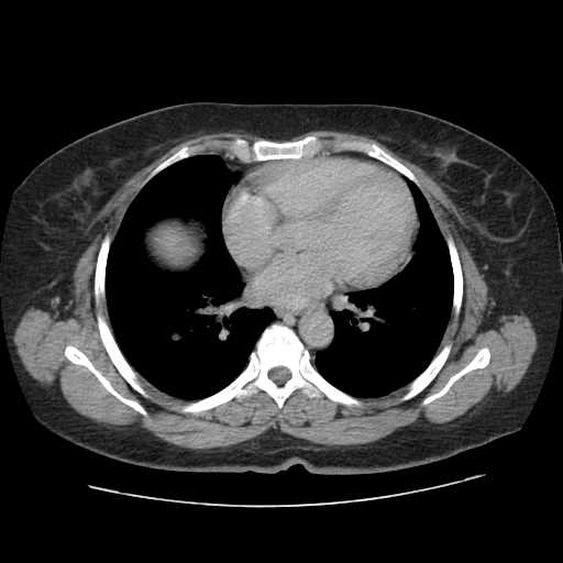 File:Autosomal dominant polycystic kidney disease with hepatic involvement (Radiopaedia 32693-33662 C 1).jpg