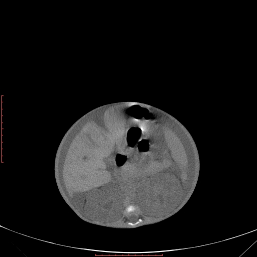 File:Autosomal recessive polycystic kidney disease associated with Caroli disease (Radiopaedia 61932-69984 B 185).jpg