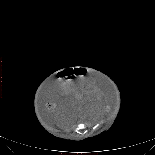 Autosomal recessive polycystic kidney disease associated with Caroli disease (Radiopaedia 61932-69984 B 259).jpg