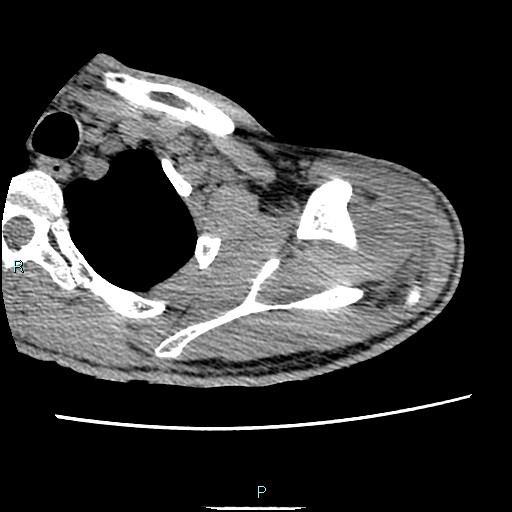 Avascular necrosis after fracture dislocations of the proximal humerus (Radiopaedia 88078-104653 D 25).jpg